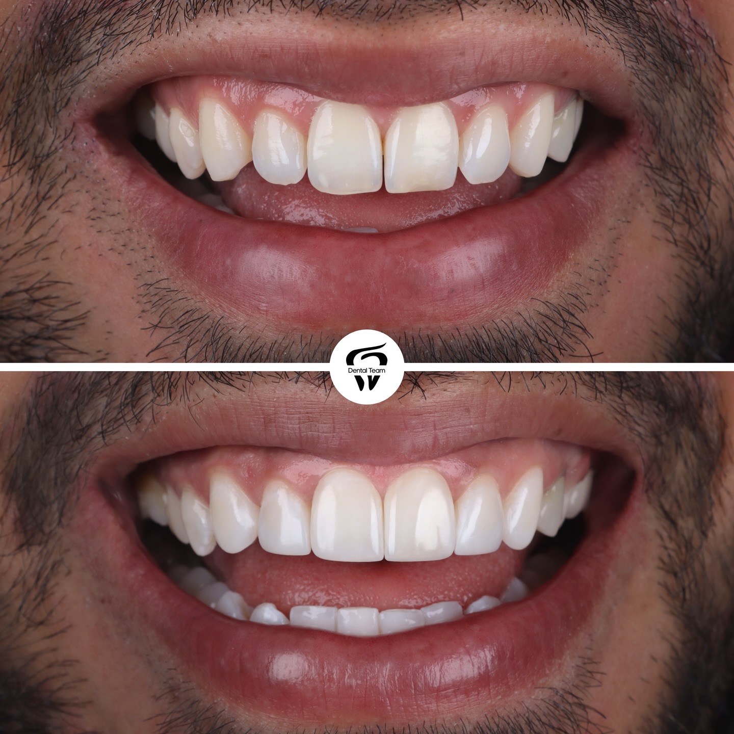 Caso de microdiseño de sonrisa 3