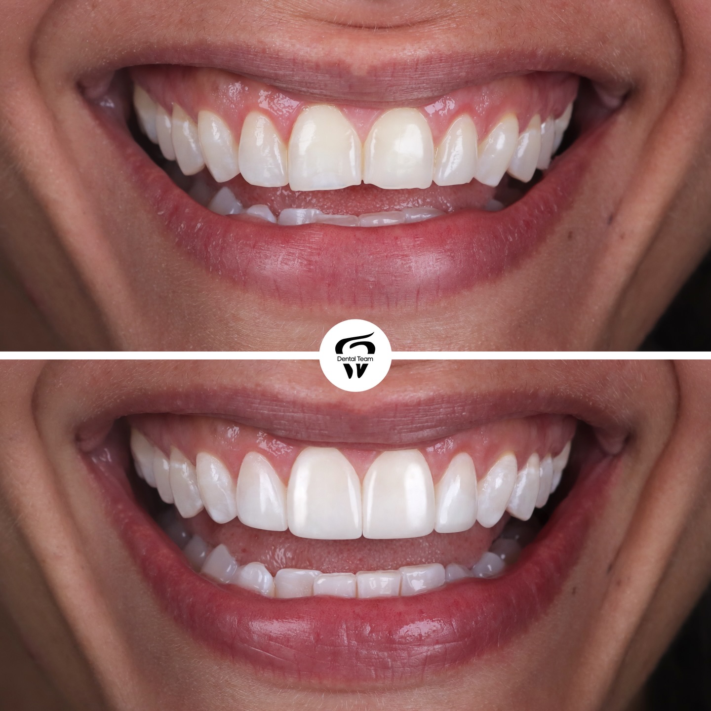 Caso de microdiseño de sonrisa 4